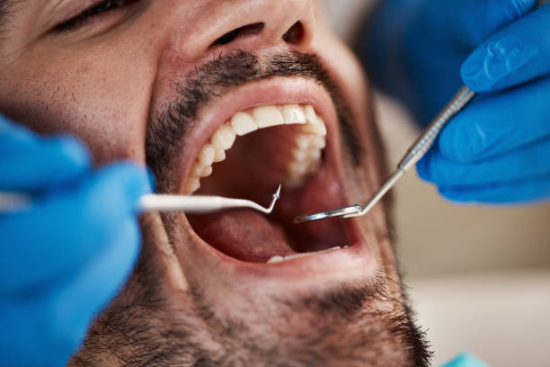 Best Emergency Dental Care for Abscessed Tooth in Hillsdale, NJ